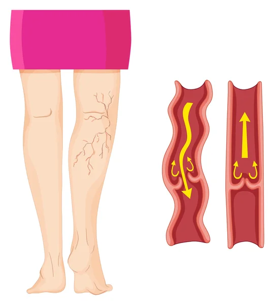 Veias varicosas na perna humana — Vetor de Stock
